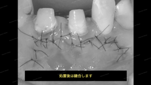歯茎の白い出来物の腫れの治し方　外科治療　６